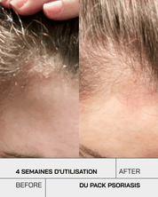 Routine Psoriasis Control - Touché Skincare Lab
