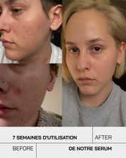 Acide Salicylique - Touché Skincare Lab