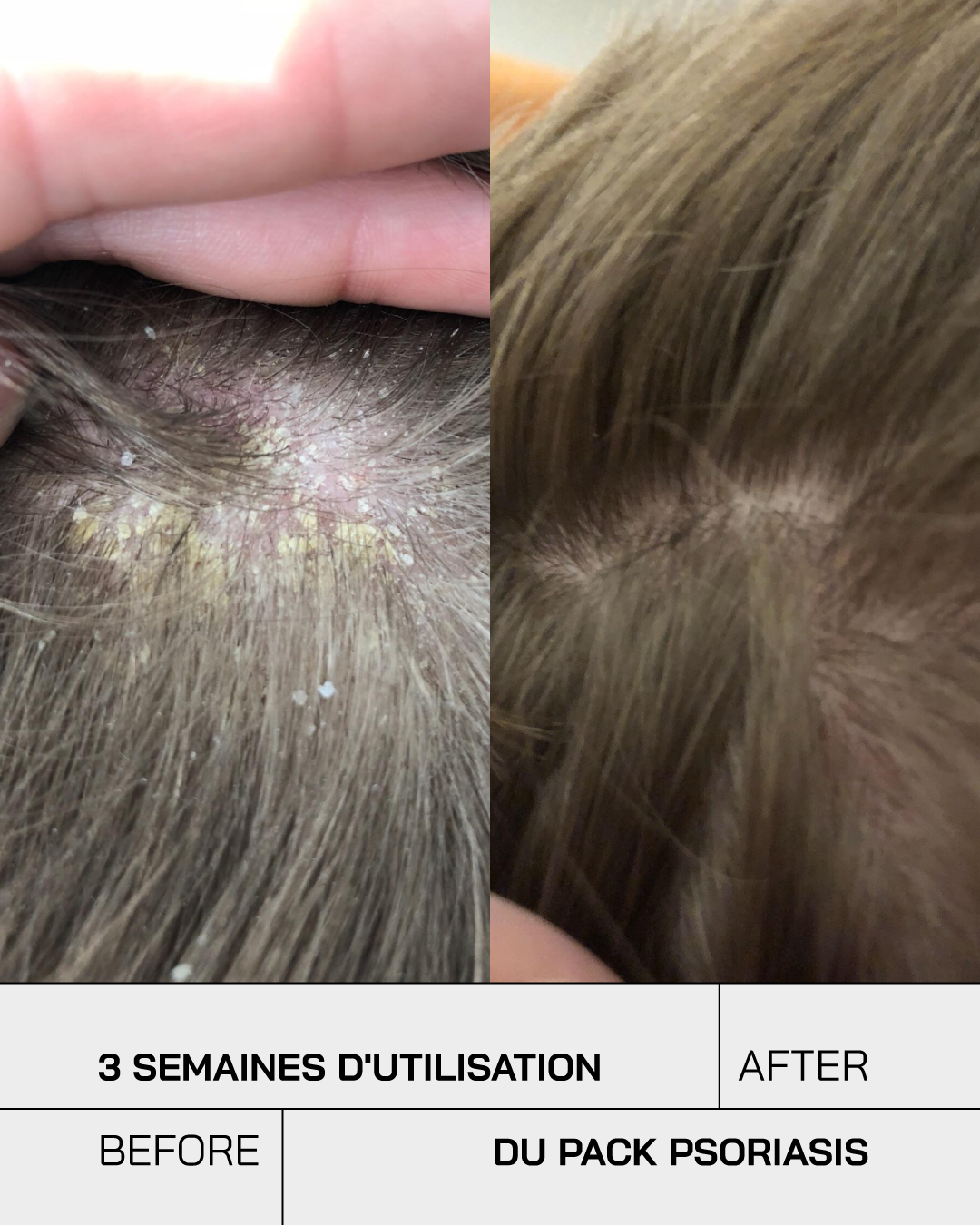 Routine Psoriasis Control Junior - Touché Skincare Lab