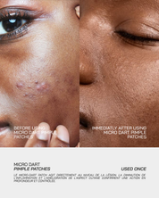 Micro-Dart Pimple Patches - Touché Skincare Lab