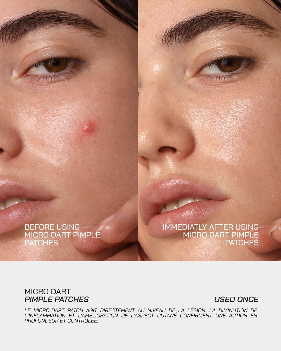 Micro-Dart Pimple Patches - Touché Skincare Lab