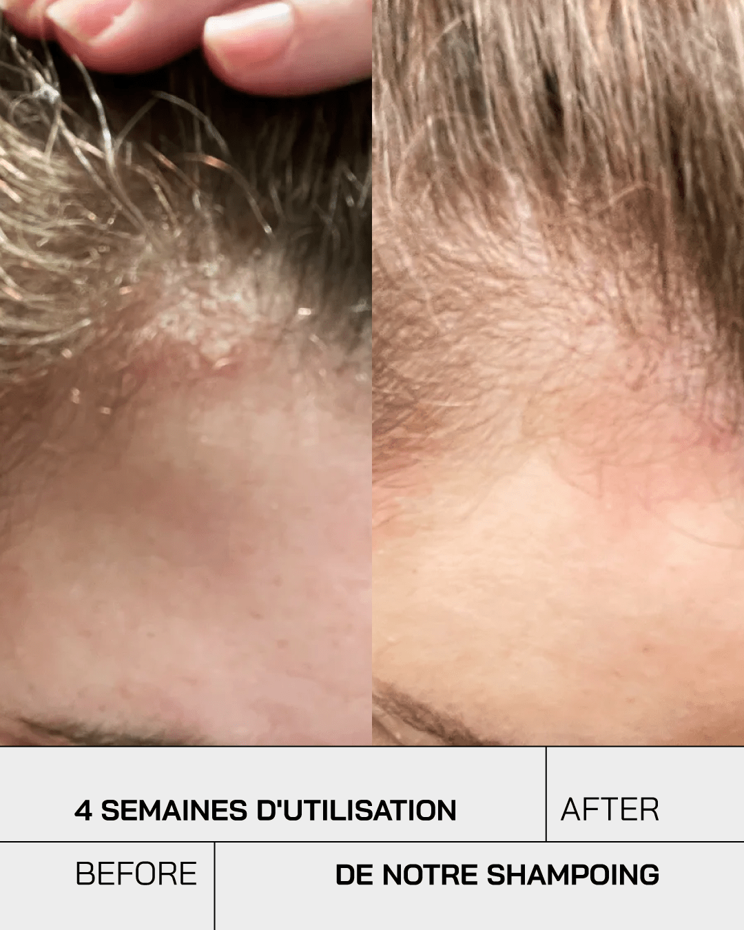 Shampoing Anti-Psoriasis - Touché Skincare Lab