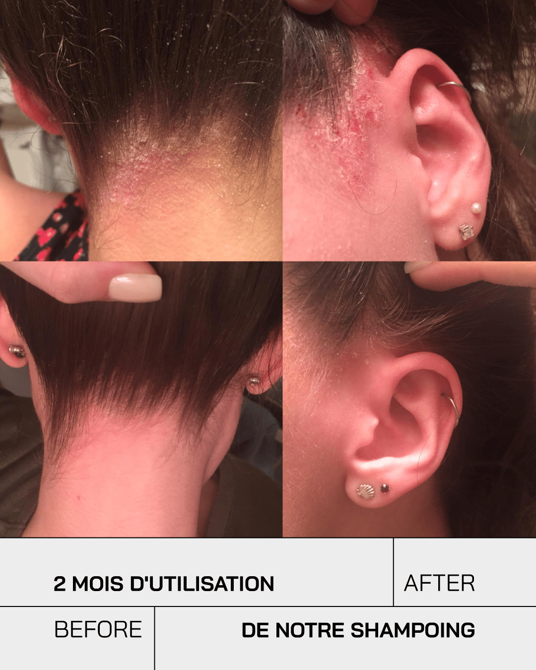 Shampoing Anti-Psoriasis - Touché Skincare Lab