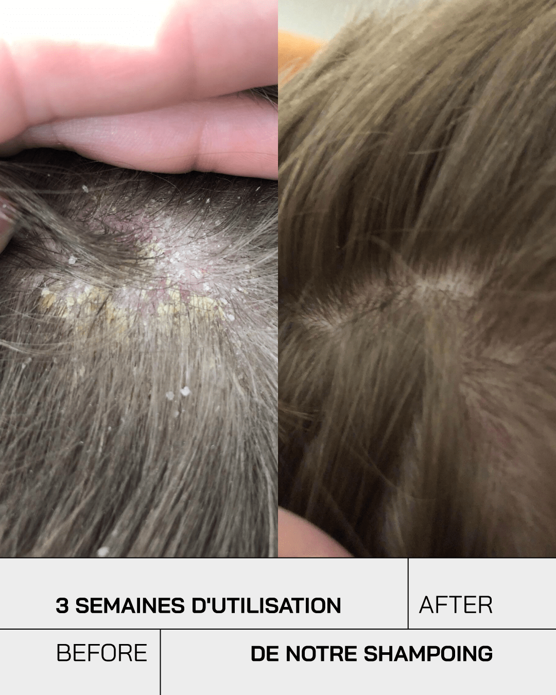 Shampoing Anti-Psoriasis - Touché Skincare Lab