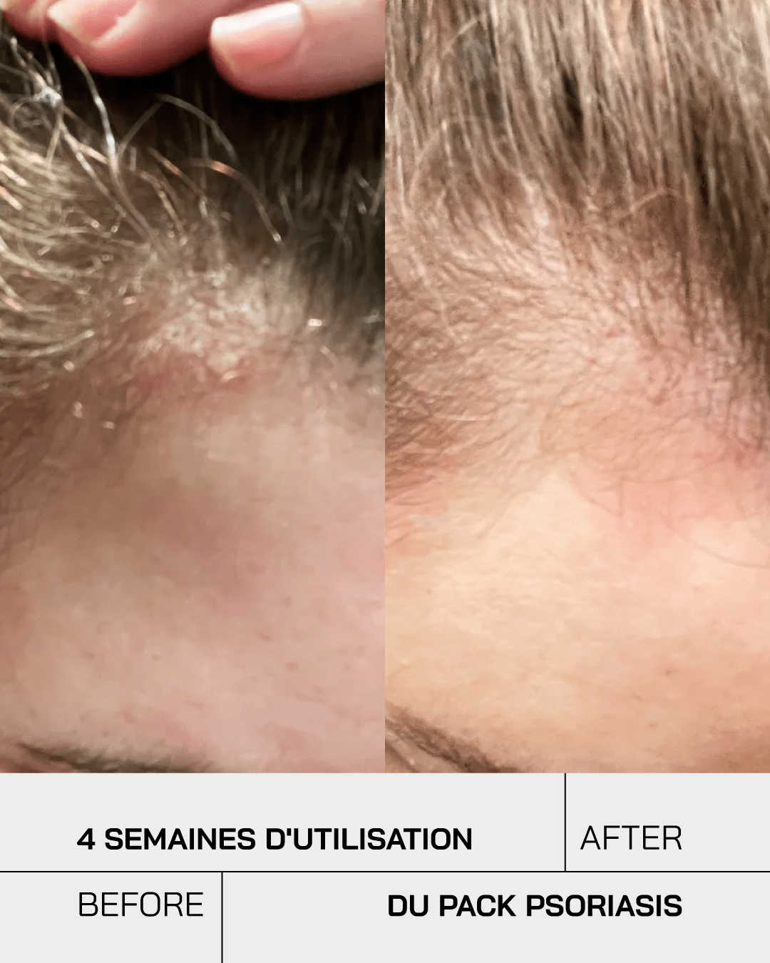 Routine Psoriasis Control Junior - Touché Skincare Lab
