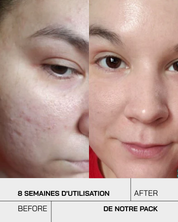 Touché Duo Anti Imperfection - Touché Skincare Lab