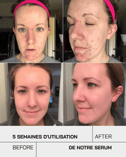 Anti Acné - Touché Skincare Lab